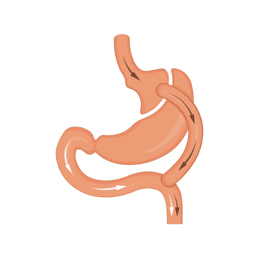 Image displaying a gastric bypass surgery diagram