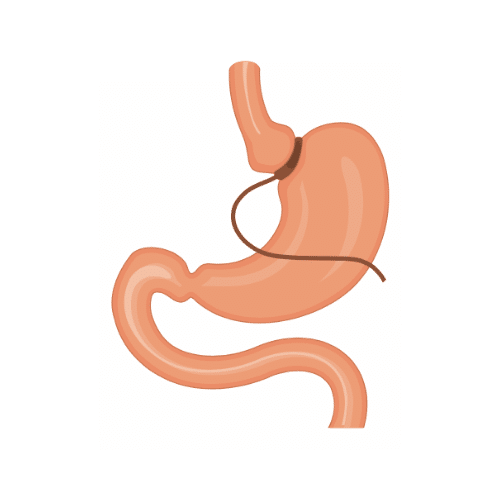 An image explaining a gastric band procedure